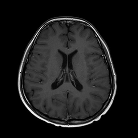 MRI Brain T1W